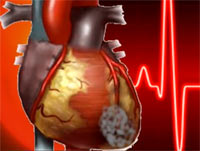 Инфаркт миокарда, симптомы и первая помощь