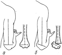 Признак В. О. Маркса при вывихе (а) и переломе плечевой кости в нижней трети (б)