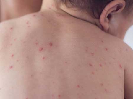 Пиодермия - гнойничковые поражения кожи у детей