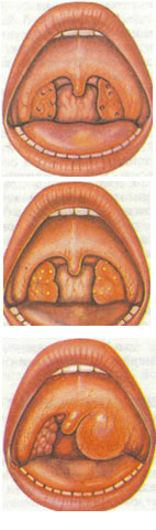 Ангина (острый тонзиллит): а — катаральная; б — фолликулярная; в — флегмонозная 