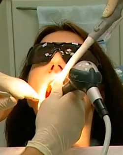 Чистка зубов, импланты, виниры -классификация и характеристики- советы от профессиональных стоматологов стоматологии vip-line