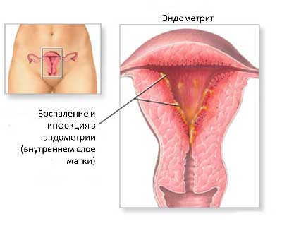 Эндометрит, симптомы воспаления внутренней оболочки матки