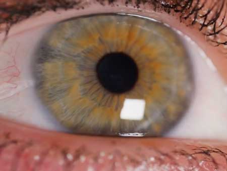 Гипертоническая болезнь, глазные проявления