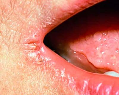 Хейлит - воспаление красной каймы губ